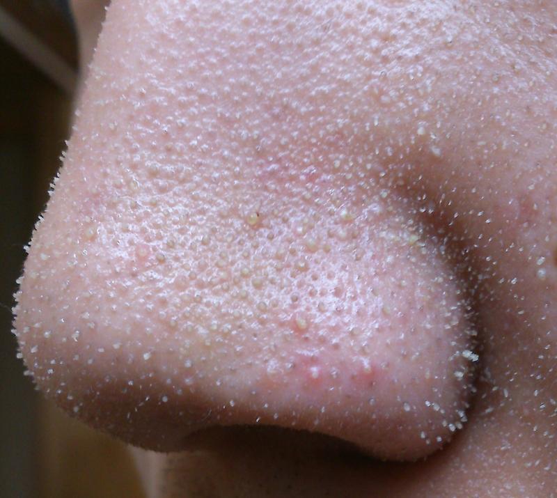 肌断食 毛穴が限界を迎えました