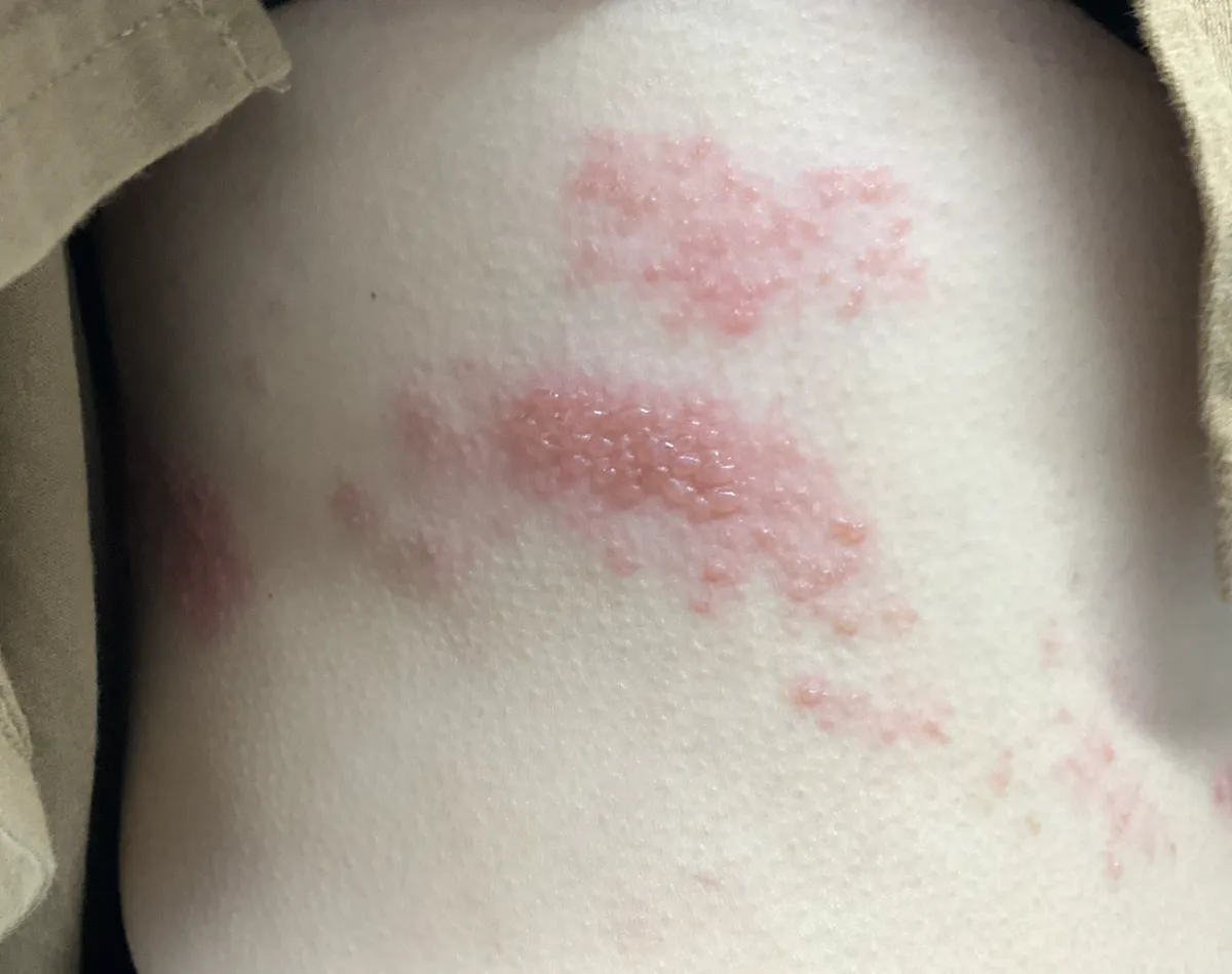 症例写真 帯状疱疹がお腹に現れたときの状態を進行段階別に解説 - 中村AJペインクリニック