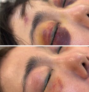 埋没法後の内出血はひどい？いつまで続く？経過や治らない場合にできることを解説 – エックスクリニックX CLINICエイジングケア・クマ治療、二重整形など・美容皮膚科・審美歯科