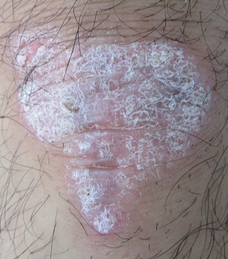 乾癬のタイプを見分けるために 種類によって違う症状について知ろうあさ美皮フ科亀戸駅前