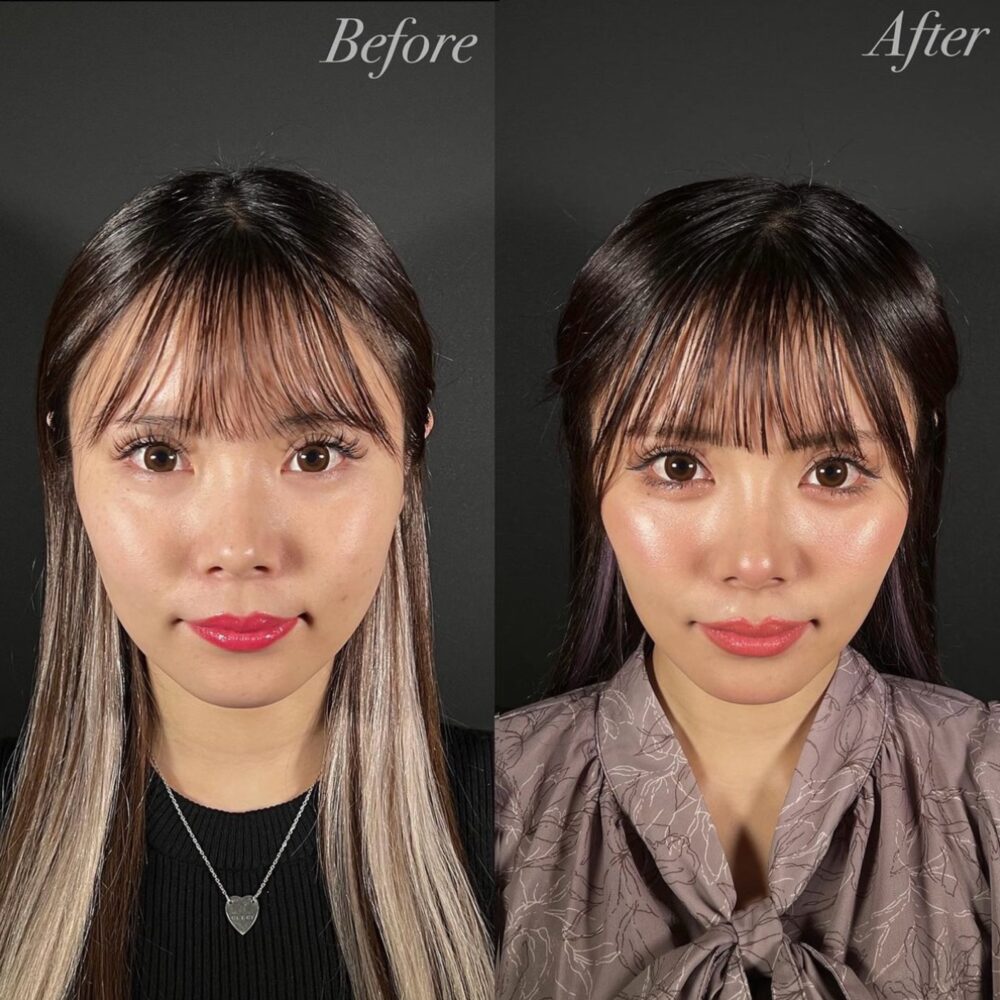 中顔面短縮と同時に下顔面も小さく。その1マックスファクス銀座クリニック ブログ