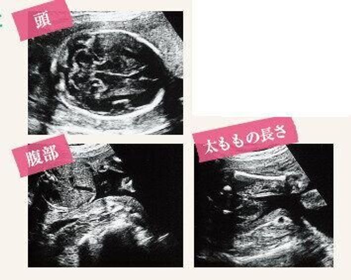 2ページ目医療監修 エコー写真を妊娠の経過別に紹介！写真の見方や性別の見分け方ママリ