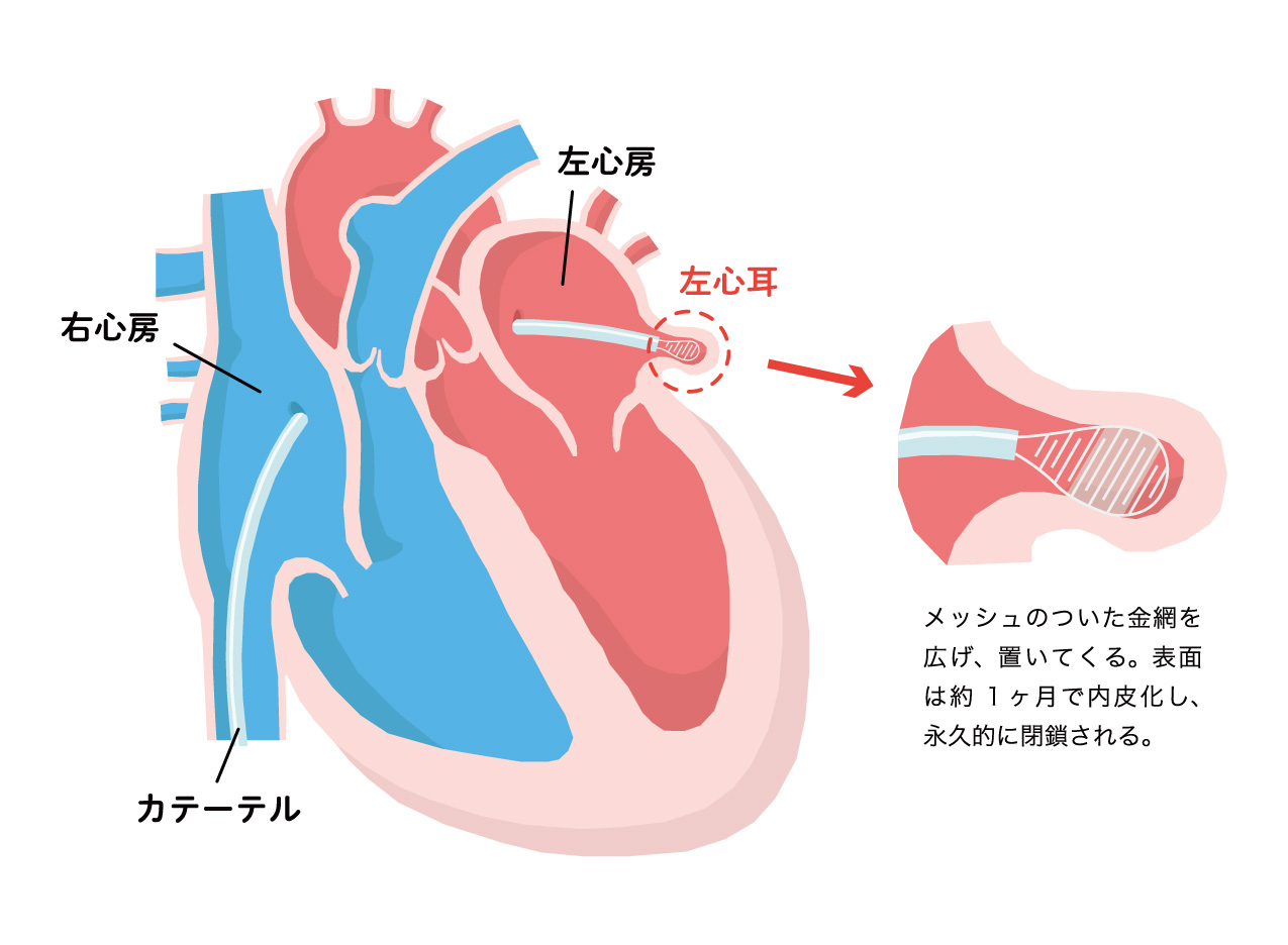 心臓自体のペースメーカ心臓再同期ペースメーカー治療 CRT-P一般・患者さんボストン・サイエンティフィック ジャパン