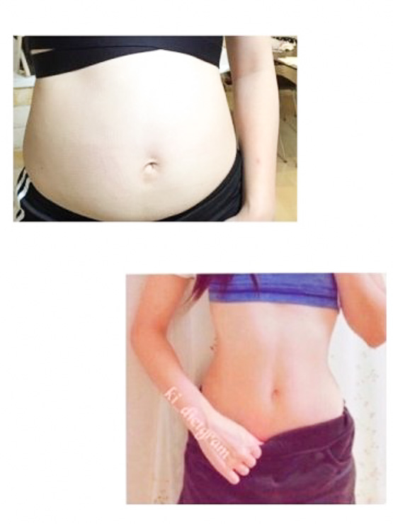 医師監修 産後ぽっこりお腹の原因と解消法「妊婦みたい」 いつまで続く？治らない？ダイエットの専門家が解説！ -URARAクリニック医療美痩身・医療ダイエット専門クリニック