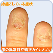 爪の異常・病気のイラストのイラスト素材93334993- PIXTA