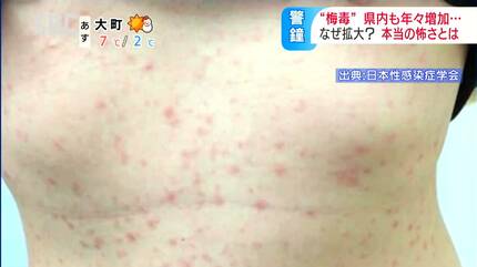 梅毒 について原因・症状・検査・治療など 吉祥寺まいにちクリニック 内科・皮膚科・泌尿器科