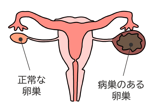 特に女性で、足の付け根 鼠径部 のリンパ節が腫れて痛む原因には何がありますか？ 股関節痛