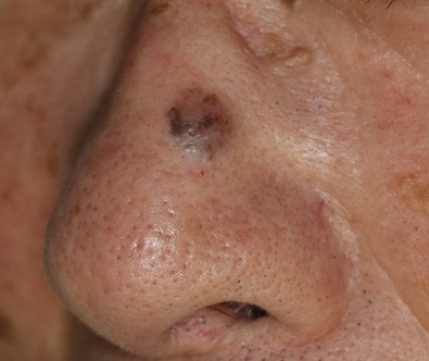 口腔癌の特徴と症状とは口腔がん.com