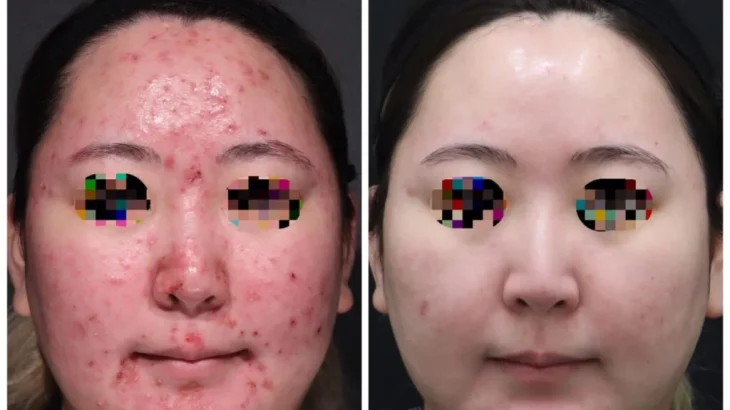 ニキビ肌を治す最短方法