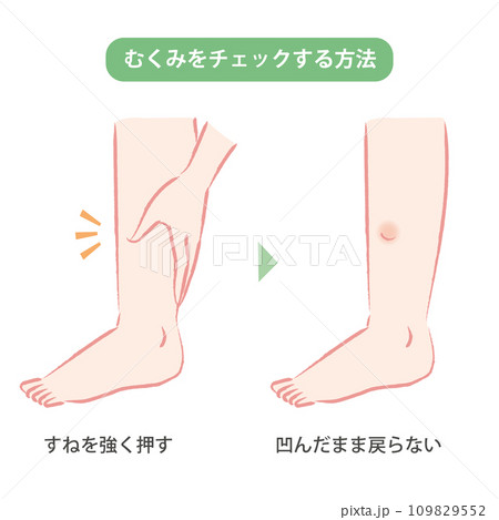 足のむくみ「むくみからのメッセージ」東京血管外科クリニック