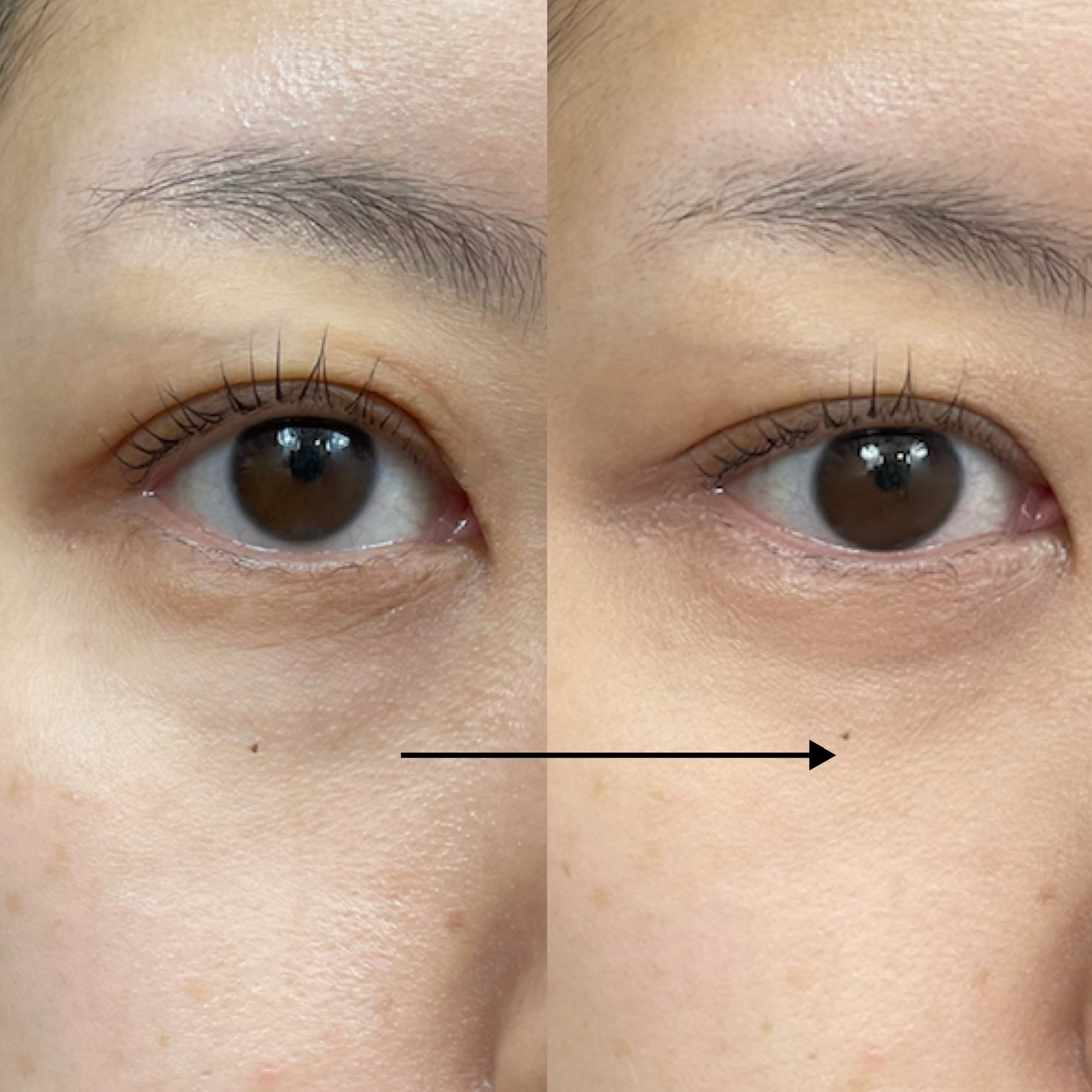 黒クマのカバーにおすすめの 人気コンシーラー を集めました♡ARINEアリネ