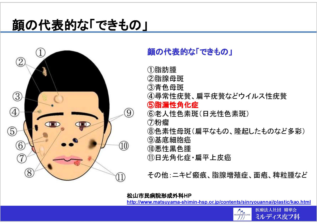イボ 尋常性疣贅:ゆうぜい- 銀座まいにちクリニック 内科・皮膚科・泌尿器科