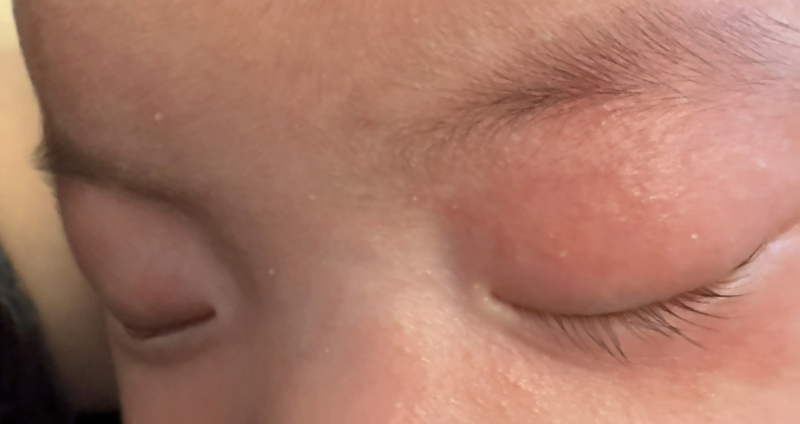 子供の霰粒腫の切開 - 溜池山王 伊藤眼科