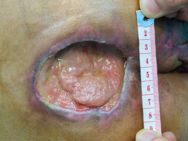 褥瘡 床ずれ 予防とケアの基本介護福祉士が解説！MySCUEマイスキュー