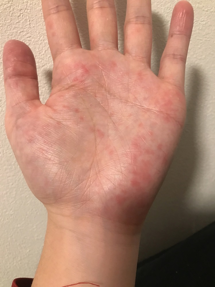 手掌紅斑伝統鍼灸 楓庵