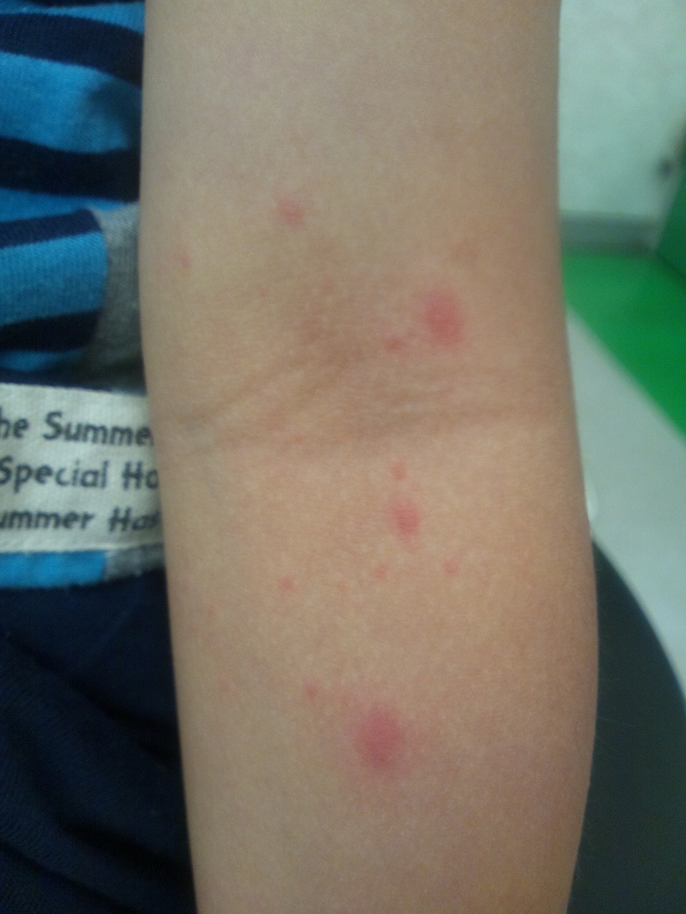 赤い斑点はかゆい？かゆくない？考えられる病気について医師が解説