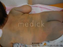 大人のあざ治療。30代女性異所性蒙古斑。 - ドクターリコの明日もＨａｐｐｙ