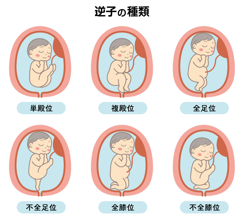 医師監修 逆子体操は効果ある？ やり方を原理から学ぼう！Infoseekニュース
