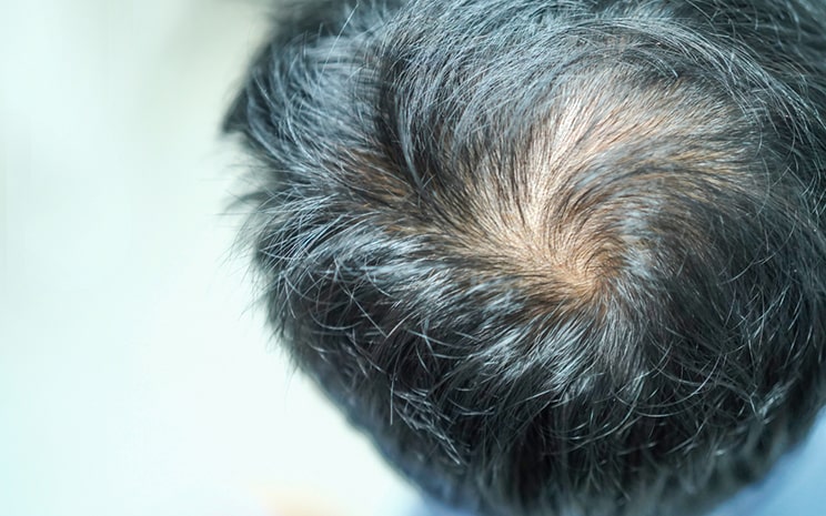 つむじが薄いかも?！』気になり出した時に ※原因と改善方法グランツクリニック