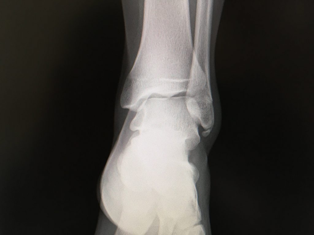 小児の足のケガについてかとう整形外科スポーツ運動器クリニック