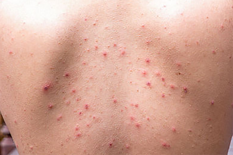 こどもの発疹の みかた—総論