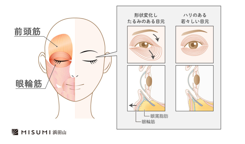 一気に老ける！目の下のたるみ⁡ こんばんは 美人ヶ丘 自由が丘です🌹 ⁡ ⁡ お顔の中でも一気に老け顔になるお悩み「目の下のたるみ」本当にやっかいですよね🥲 ⁡ ⁡ そもそも目の下がたるむ原因のひとつとして目元の筋肉の衰えがあげられます。 ⁡ ⁡ 目の下のたるみと