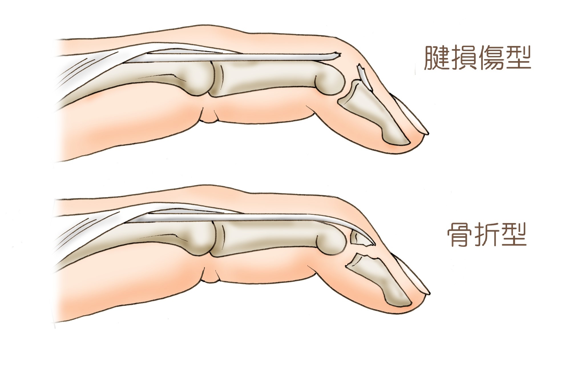 手首・指が痛い 岐阜市・岐南町しみず整形外科リハビリクリニック