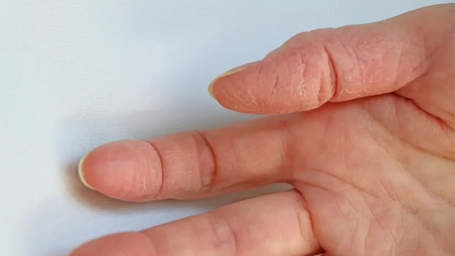 手湿疹におすすめのハンドクリーム8選 ランキング形式で紹介健康肌スキンケア