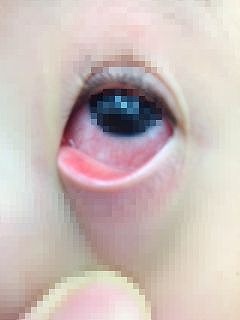 新幹線で霰粒腫切開に来た男の子