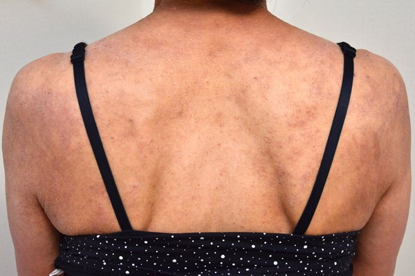 赤ちゃんのお腹・背中に赤い湿疹が！あせもやアトピーの正しい対処 医師監修kosodate LIFE 子育てライフ