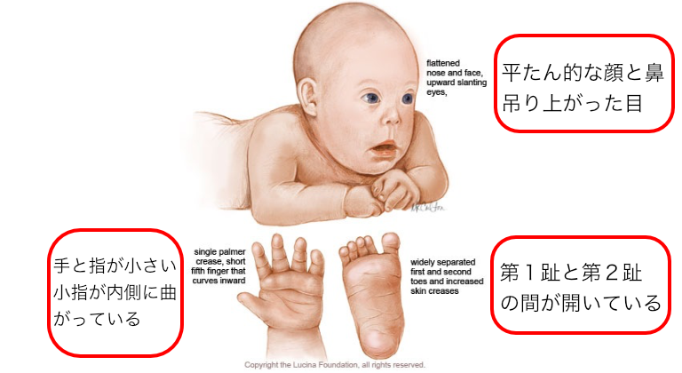 ダウン症の赤ちゃんの見分け方は？発症の原因や特徴、検査方法も解説NIPT 新型出生前診断 のコラム - 平石クリニック