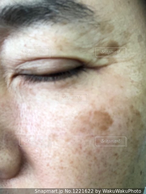 シミ治療 治療方法とシミの種類徳島の美容クリニック 赤池クリニック