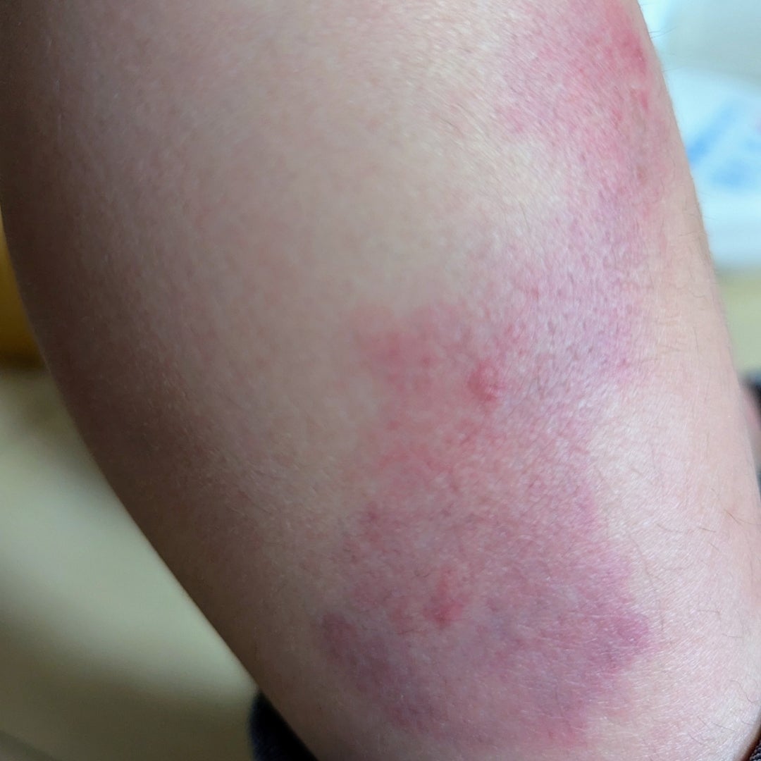 虫刺され・水前寺皮フ科医院熊本市の皮膚科・形成外科・アレルギー科