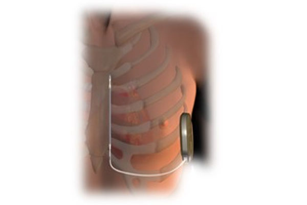 心臓突然死を防ぐ植込み型除細動器 ICD: とよない院長ブログ