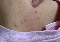 首のニキビの原因と対策 - ニキビ研究室 医師監修ニキビ治療はニキビ専門皮膚科のオラクル美容皮膚科 ニキビ外来