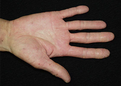 汗疱吹田市の皮膚科もりはら皮ふ科クリニック