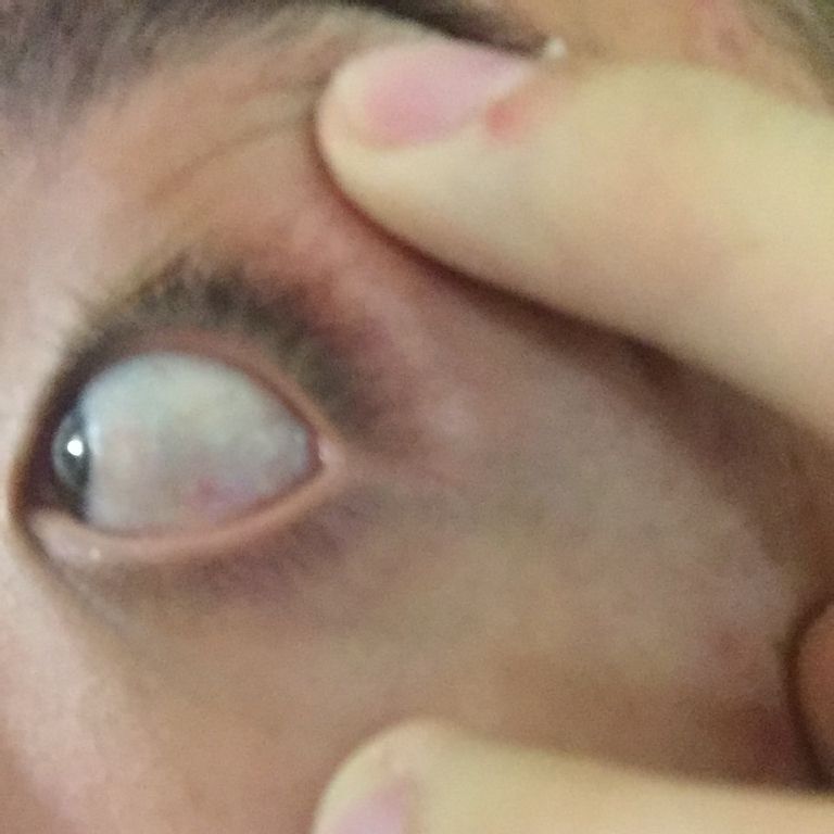 從眼睛讀出肝臟求救訊號– 用芯看世界張芯瑜眼科醫師