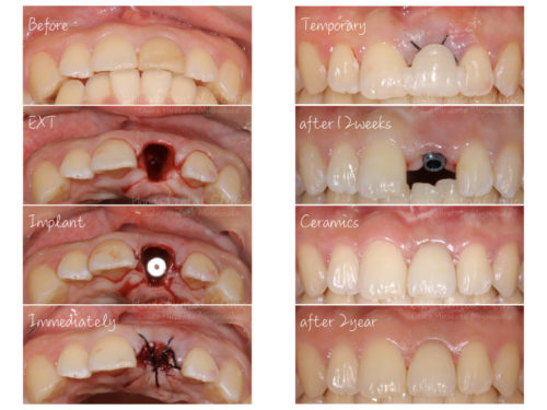 インプラント症例 - アイデンタルクリニック