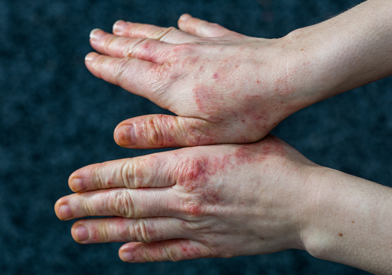 美容師を悩ませる手荒れの原因は？予防や対策、ケア方法について解説採用ブログピアスグループ 美容職採用サイト