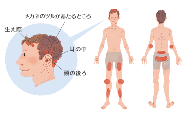 9,800点を超える乾癬 写真のストックフォト、写真、そしてロイヤリティフリーの画像 - iStock