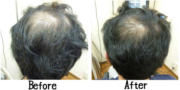 写真付き つむじはげの見分け方＆原因を解説！初期から重度まで6つの対策もご紹介The Style Dictionary