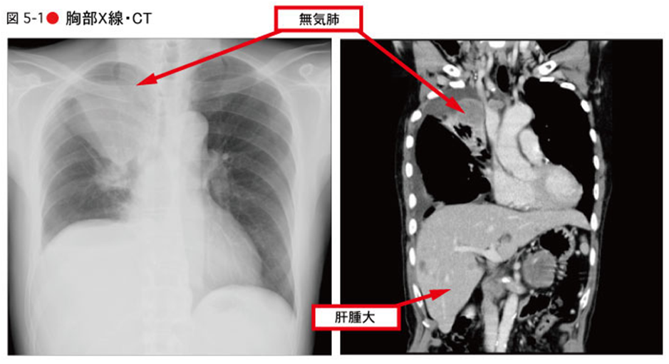 術後に無気肺が起こる3つの原因とは？予防方法や肺炎との関連を解説レバウェル看護 お役立ち情報