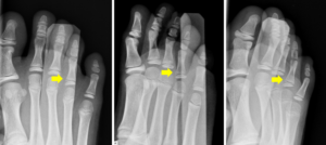 指の骨が折れた、手術なしで治療、指の骨折