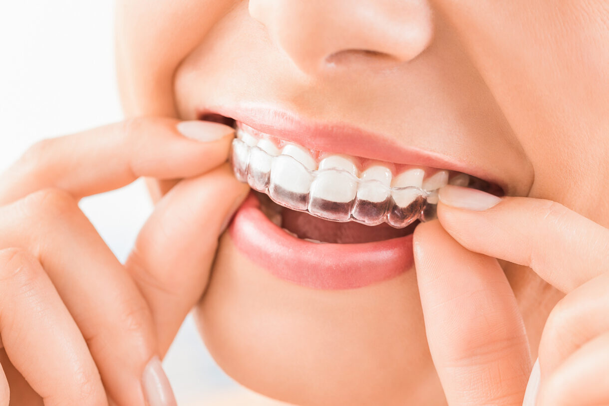 ひなのワイヤー矯正が一旦終了👏, 思っていたより早く取れて嬉しい🥺💕,撮影の時も歯を出して笑うの嫌で口閉じてたけど、それはそれで笑いにくかったみたいです。,ひなは歯が生えた頃から反対咬合だったので、ずぅーっと歯医者さん通ってたんですけど、成長と共に反対咬合も治る事があると言うことで経過観察してました。,だいたいは治ってきたんですけど、まだ4番が重なってたんですよね。,