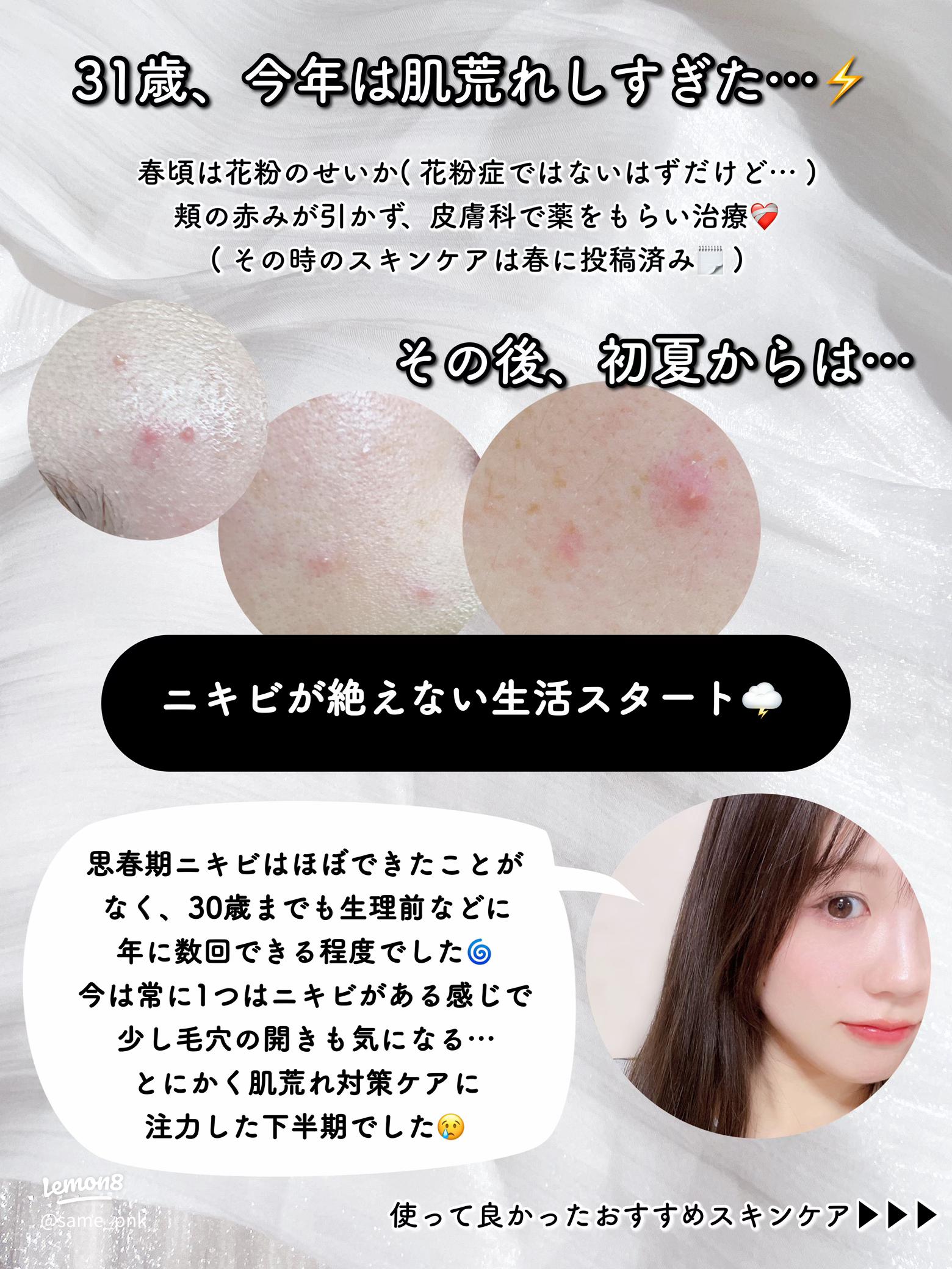 混合肌におすすめのスキンケアアイテム18選 毛穴やニキビが気になる時は？Oggi.jp