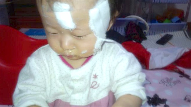 生後5ヵ月 〜異所性蒙古斑〜レーザー治療を受けました。1回目 - つなちむ