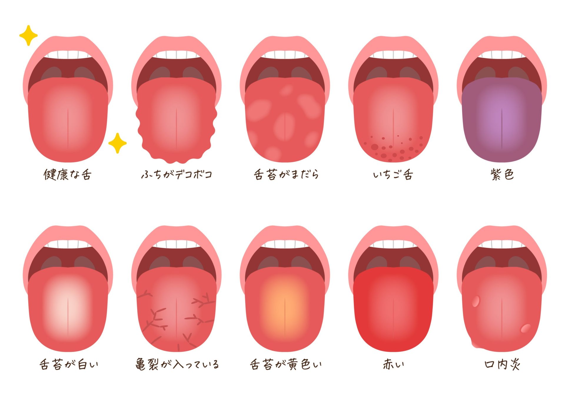 舌がひび割れるのはなぜ？原因や治療法を解説 - 武蔵中原の歯医者なら、中林デンタルケアークリニック武蔵中原駅徒歩5分の歯科医院