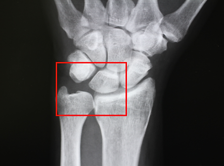 TFCC損傷とは？症状・原因・治療法を解説やまべ整形外科