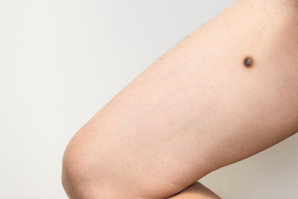 大丈夫？ その ほくろ は 皮膚がん なのかセルフチェック！ 足の裏のほくろ は除去した方がいいのか見分け方について