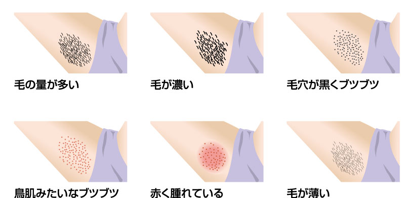 脇にできるブツブツの正体 脇にできるブツブツ、肌トラブルの予防・病気の見分け方皮膚科医が解説ヨガジャーナルオンライン